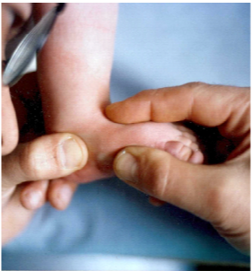 Traitement fonctionnel des malpositions et malformations des pieds des nourrisons