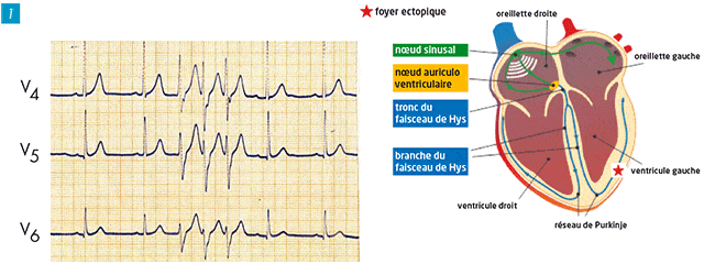 Soirée SARMUR paramed : Lecture ECG 06/2025
